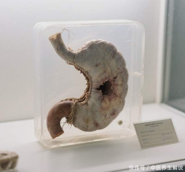 场外配资炒股 胃炎一发现就成胃溃疡？身体若出现“2多1痛”，建议尽早去做胃镜